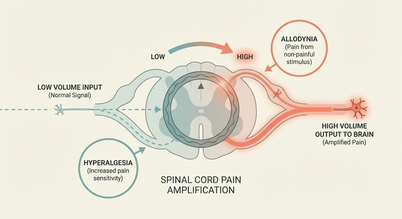 Illustration showing how central sensitization in the spinal cord amplifies pain signals from damaged nerves, turning up the volume on neuropathic pain