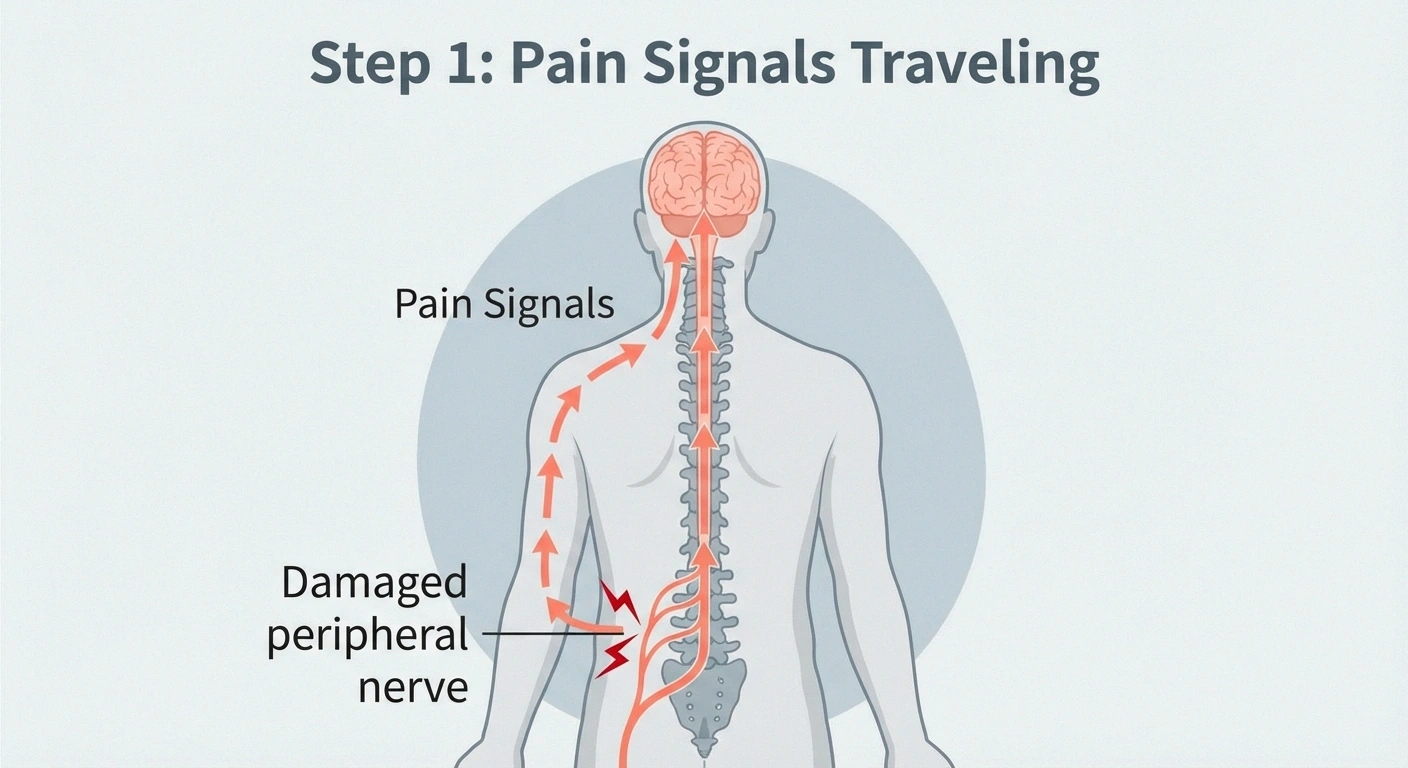 Diagram showing how spinal cord stimulation intercepts pain signals from damaged nerves using the gate control theory to reduce neuropathic pain perception