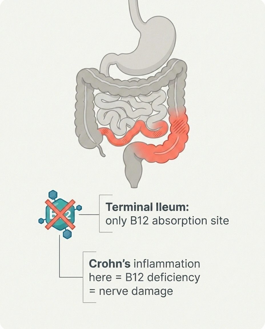 Anatomical diagram showing how Crohn's disease in the terminal ileum blocks vitamin B12 absorption and causes neuropathy