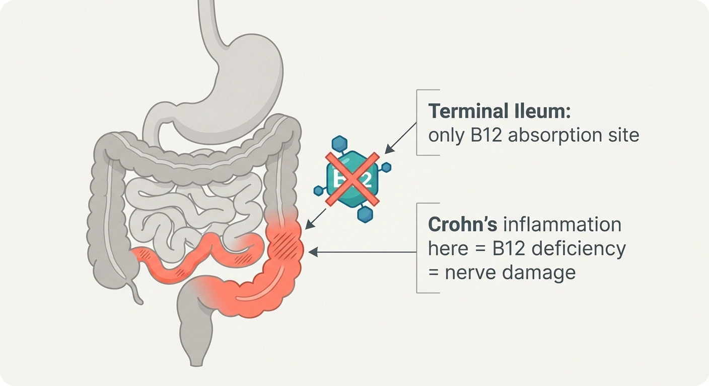 Anatomical diagram showing how Crohn's disease in the terminal ileum blocks vitamin B12 absorption and causes neuropathy