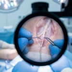 Surgeon performing peripheral nerve decompression surgery to treat neuropathy