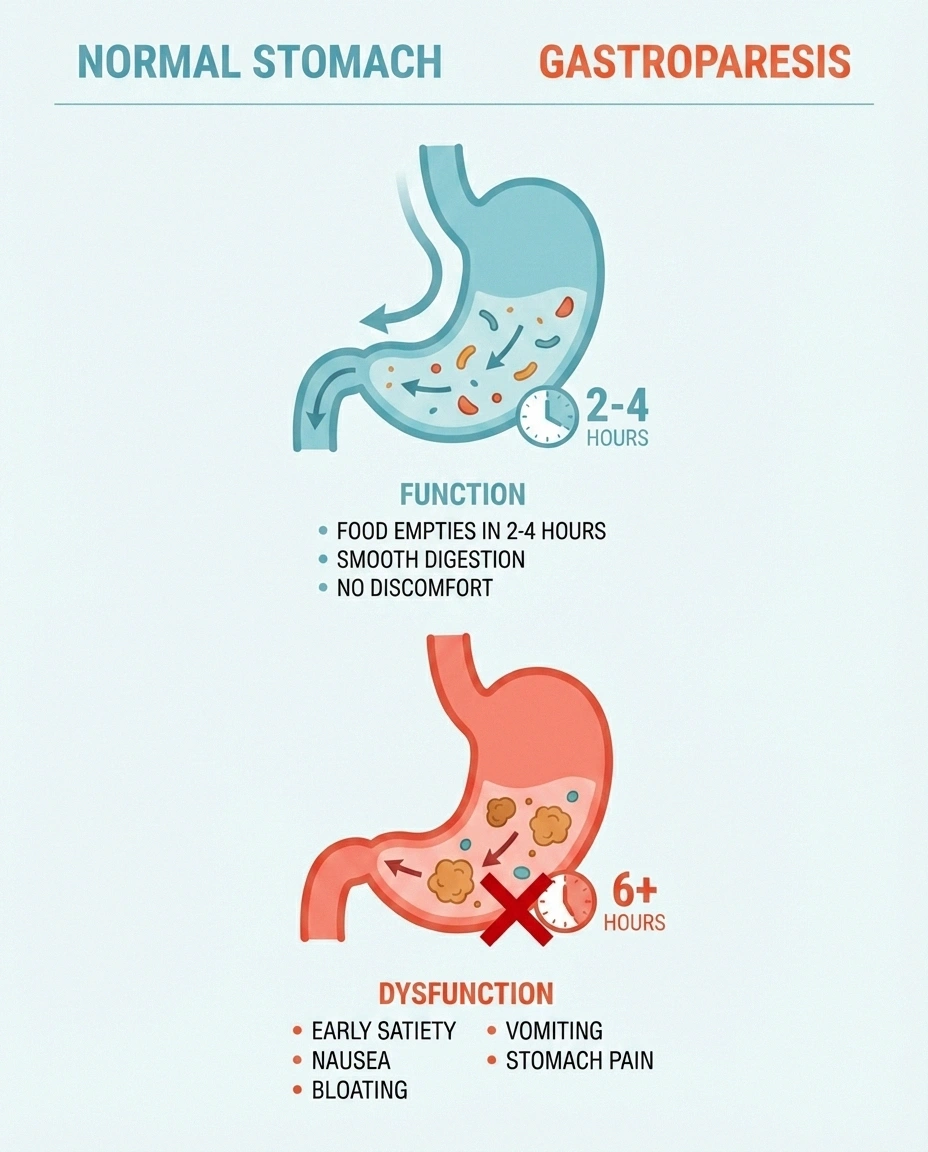 Comparison infographic showing normal stomach emptying versus gastroparesis with symptoms of delayed emptying caused by neuropathy