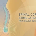 Illustration of a spinal cord stimulation device implanted near the spine for neuropathy pain relief showing the pulse generator and electrode leads