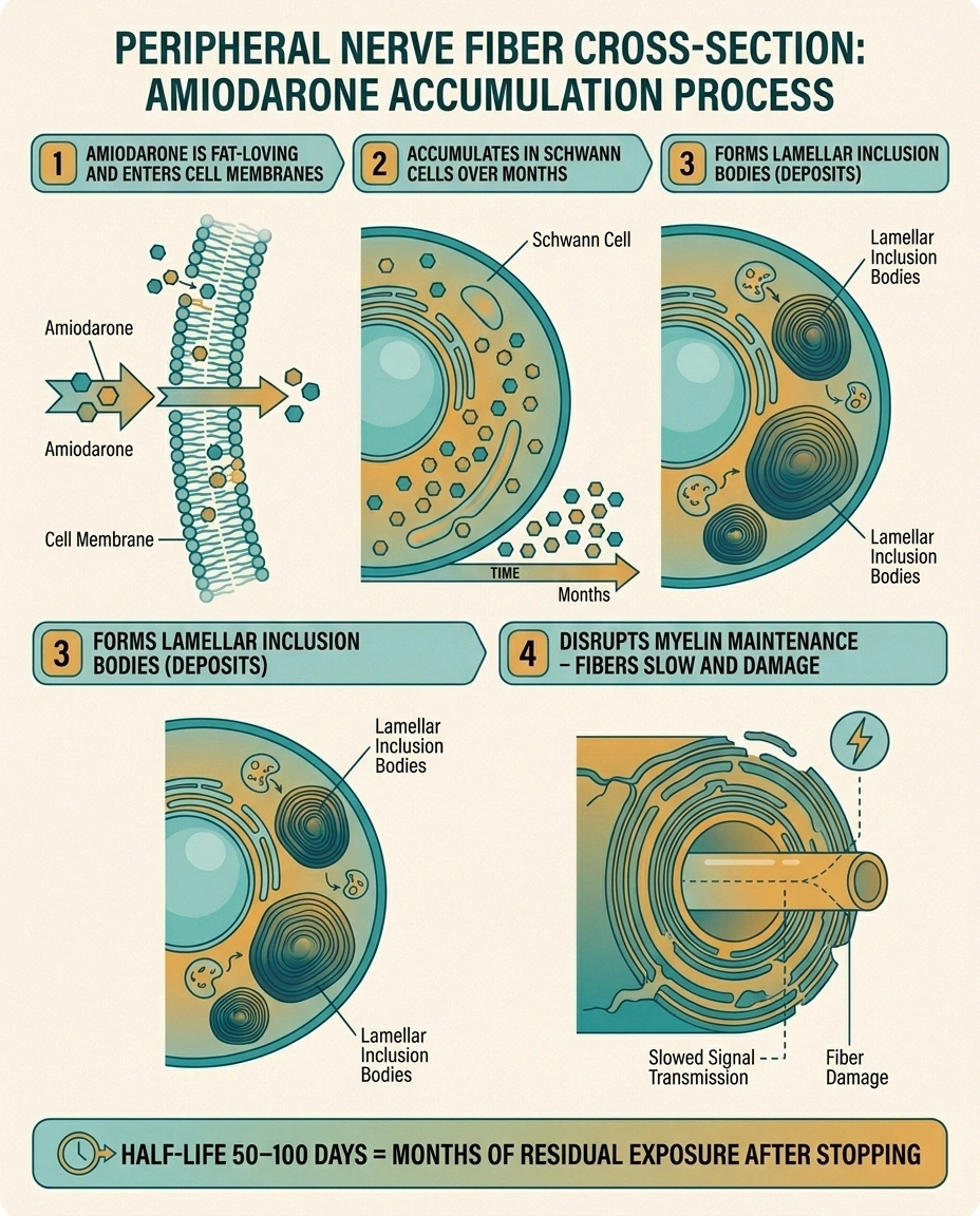 Four-step infographic showing how amiodarone accumulates in Schwann cells and forms lamellar inclusion bodies that disrupt myelin in peripheral nerves