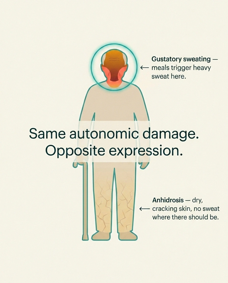 Full-body diagram showing facial gustatory sweating zones contrasted with anhidrosis (dry skin) on the feet and lower legs