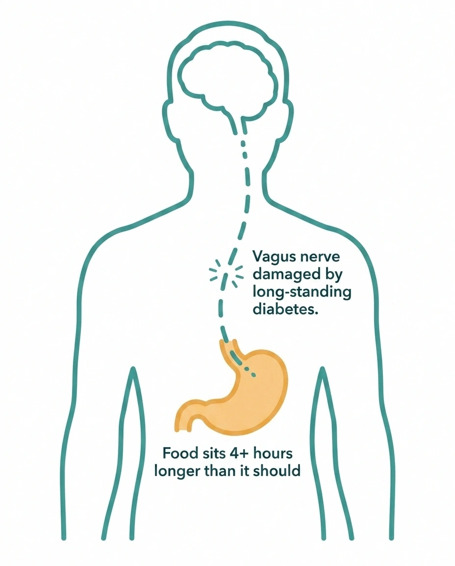 Diabetic gastroparesis caused by vagus nerve damage from long-standing diabetes