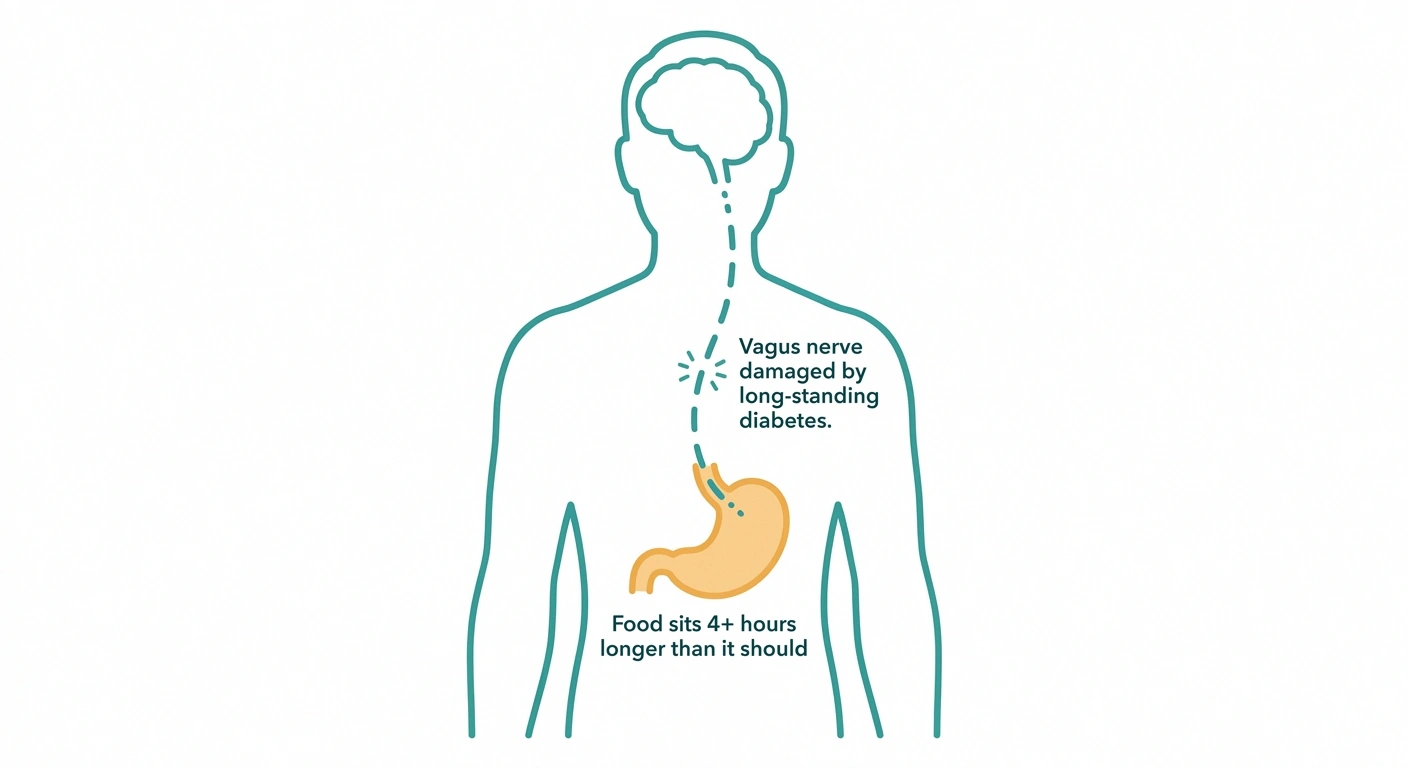 Diabetic gastroparesis caused by vagus nerve damage from long-standing diabetes