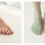 mortons-neuroma-vs-neuropathy-hero