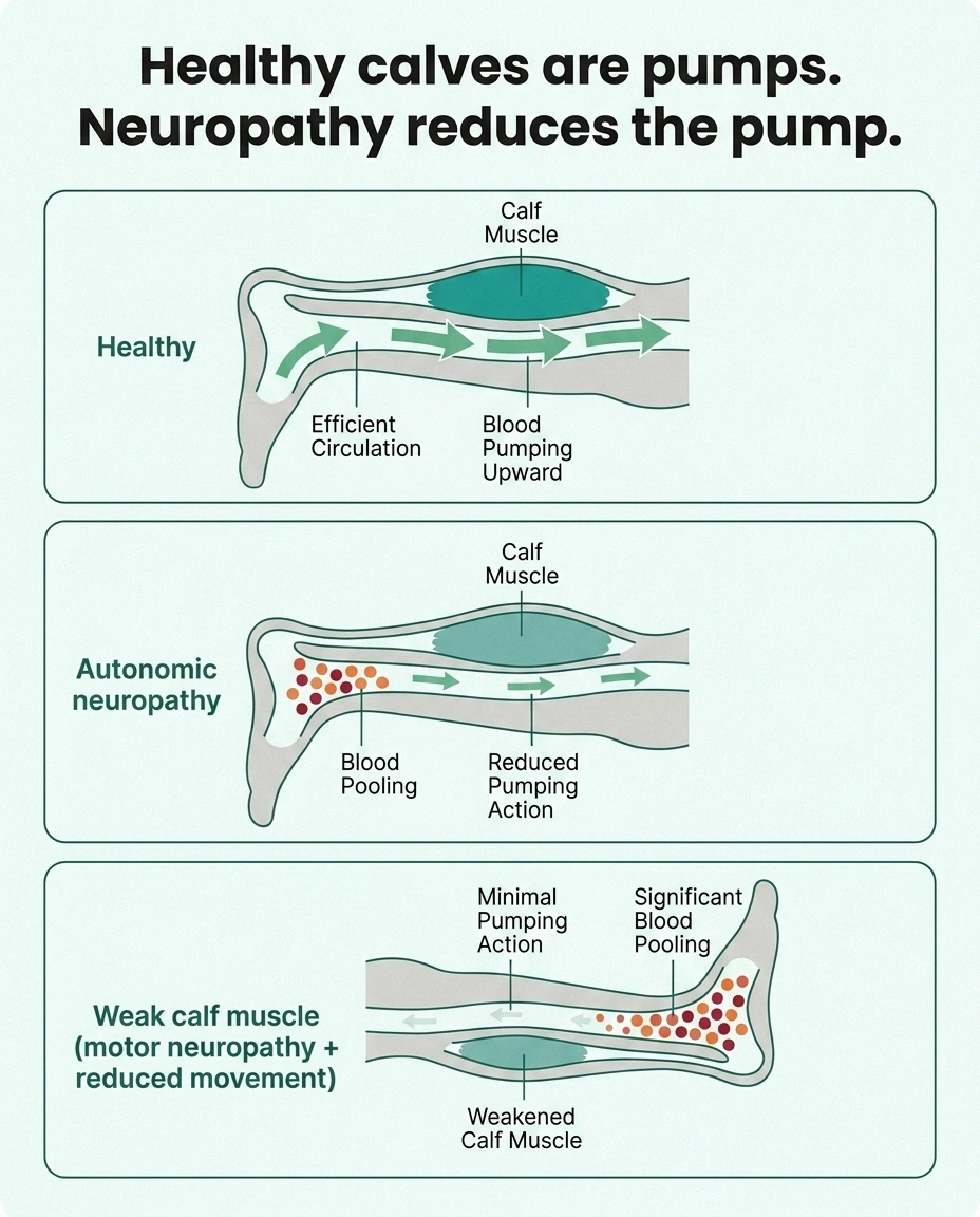 Infographic showing how autonomic neuropathy and weakened calf muscles reduce venous return and allow fluid to pool in the ankles.