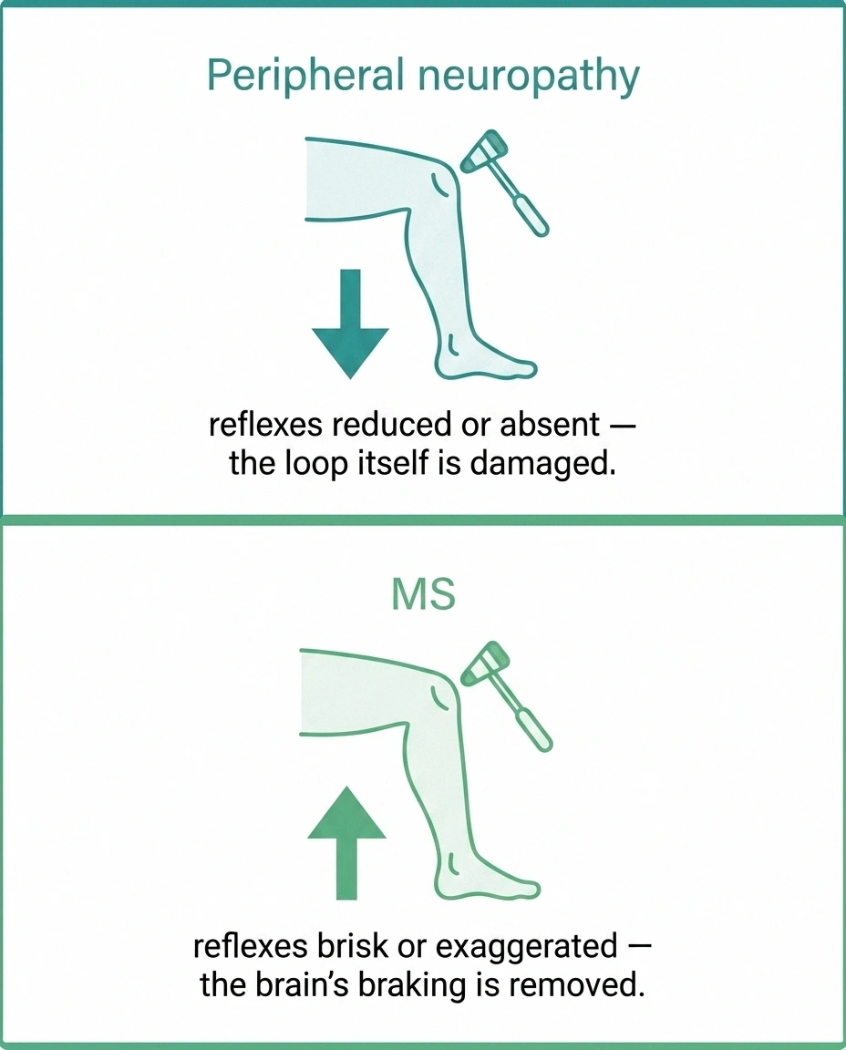 Two-panel infographic showing reflexes decrease in peripheral neuropathy and increase in multiple sclerosis when tested with the same reflex hammer.
