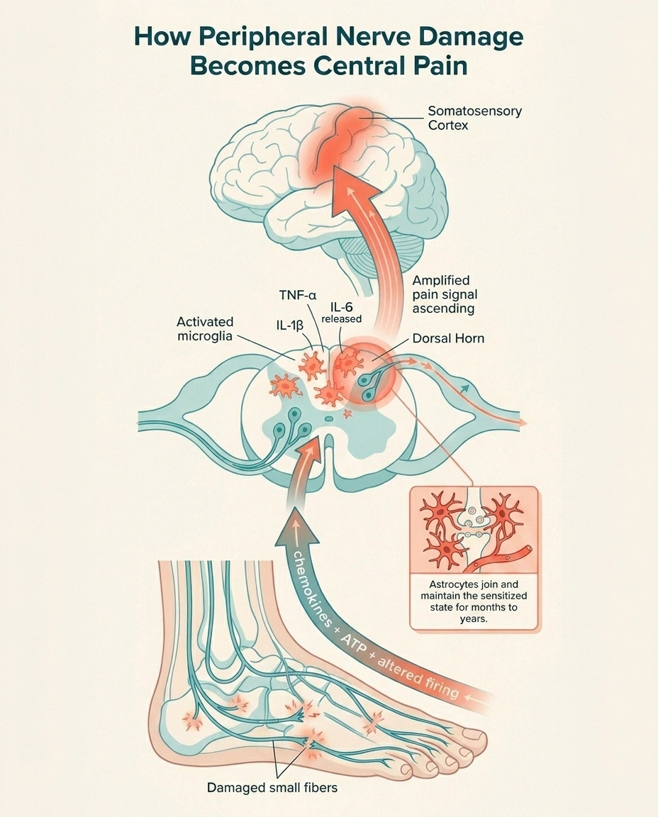 A vertical infographic showing peripheral nerve damage in the foot sending signals up to activated microglia in the spinal cord dorsal horn, which then send amplified pain signals to the brain.