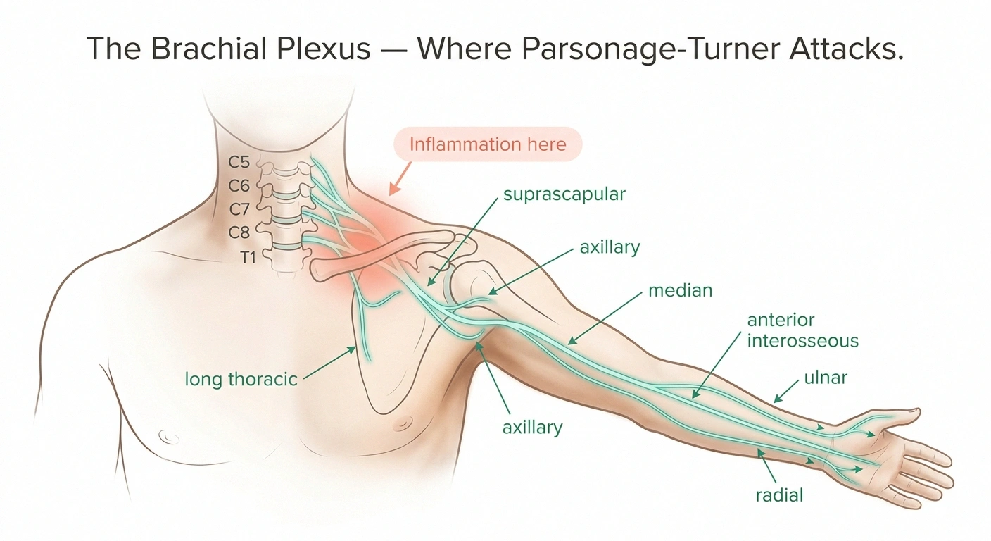 Anatomical infographic of the brachial plexus showing inflammation in Parsonage-Turner syndrome and the major peripheral nerves that branch from it