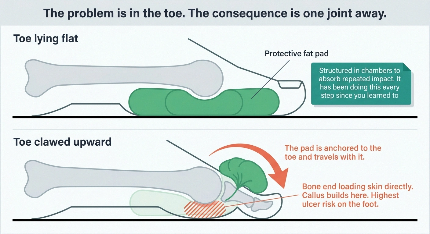 Cross-section showing the foot fat pad sliding forward when a toe claws upward