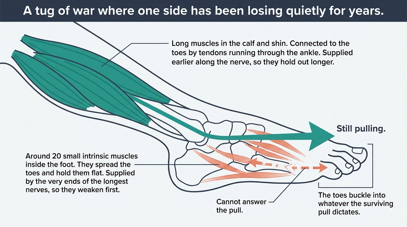 Diagram of calf tendons overpowering weakened small muscles inside the foot
