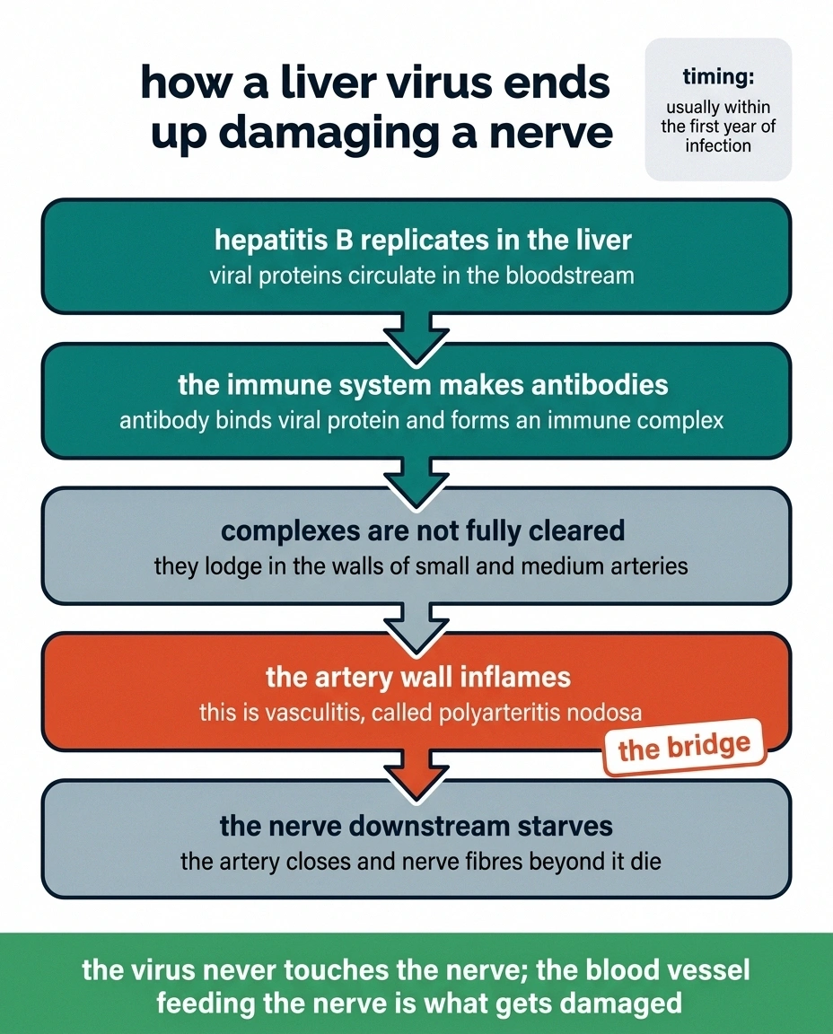 Five-stage diagram showing how hepatitis B leads to vasculitis and then to nerve damage.