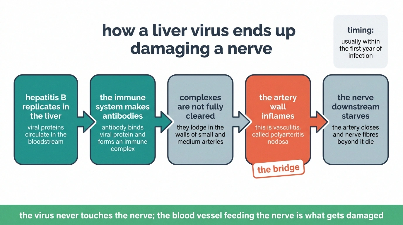 Five-stage diagram showing how hepatitis B leads to vasculitis and then to nerve damage.