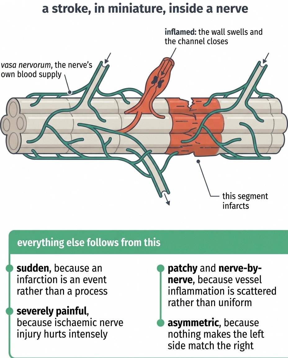 Schematic of a nerve trunk showing an inflamed blocked vasa nervorum vessel and the infarcted segment downstream.