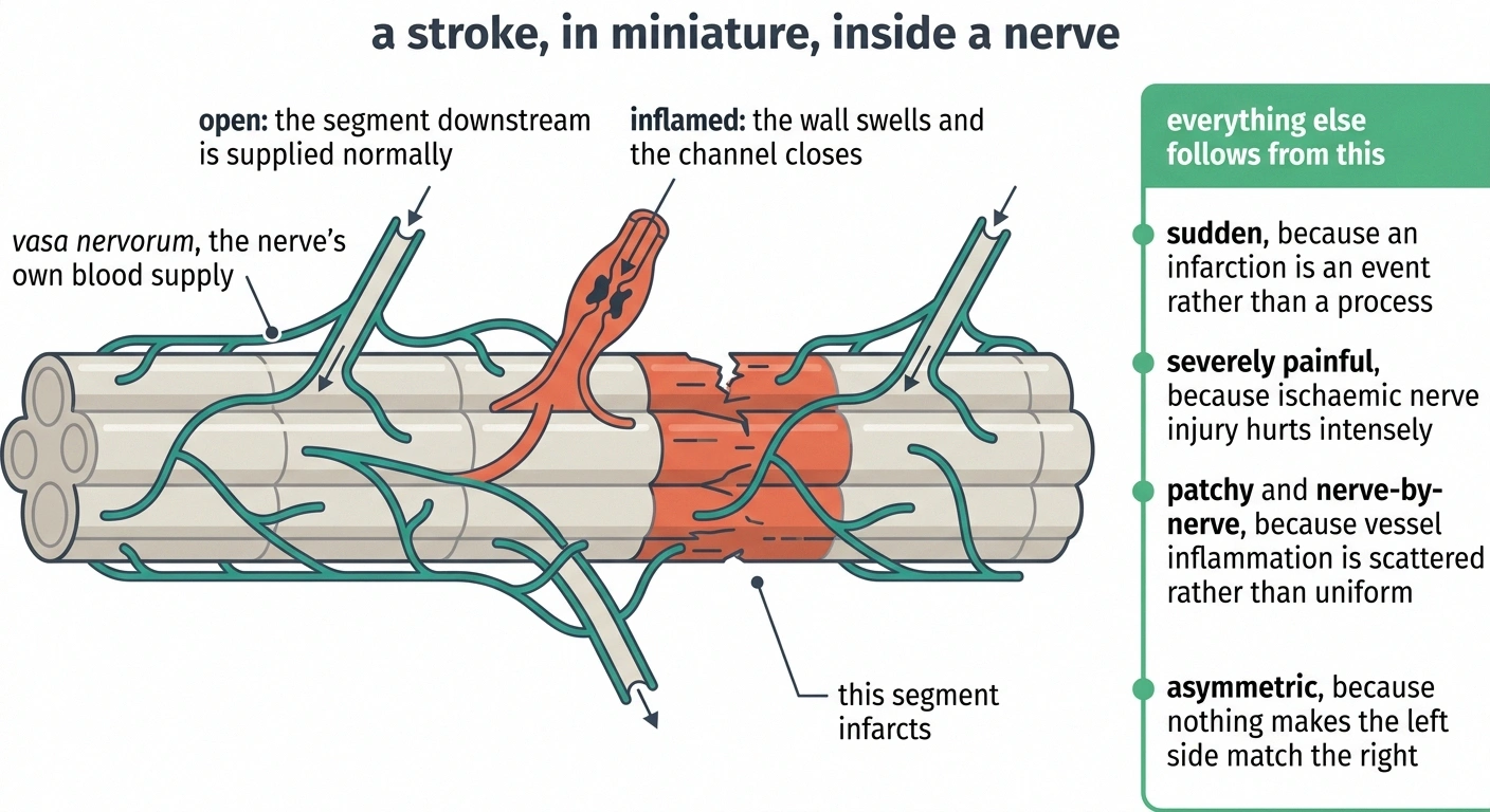 Schematic of a nerve trunk showing an inflamed blocked vasa nervorum vessel and the infarcted segment downstream.