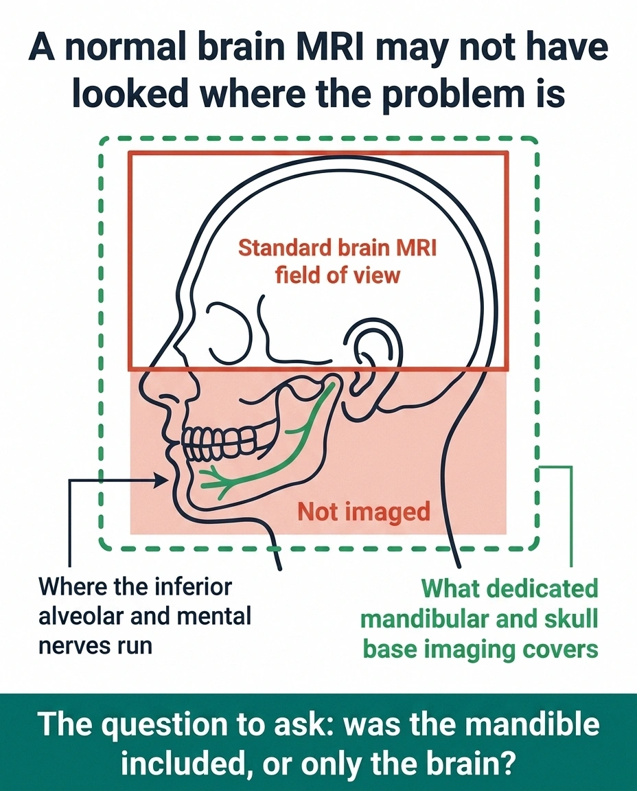Diagram showing a standard brain MRI field of view stopping above the jaw where the nerve runs